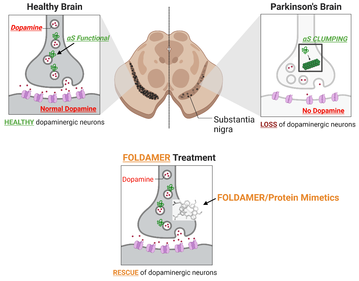 Graphic illustrating Parkinson's